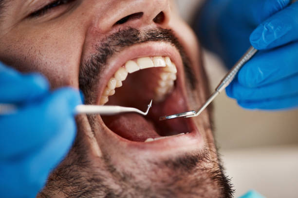 Best Emergency Dental Care for Broken or Chipped Teeth in Millers Creek, NC