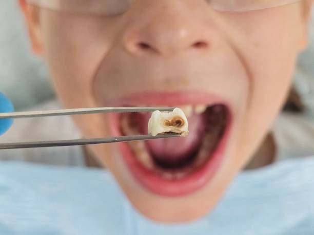 Best Emergency Treatment for Dental Infections or Abscesses in Millers Creek, NC