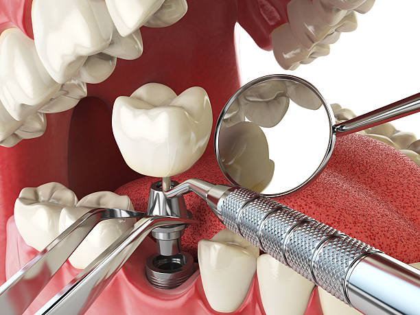 Best Urgent Care for Lost Fillings or Crowns in Millers Creek, NC